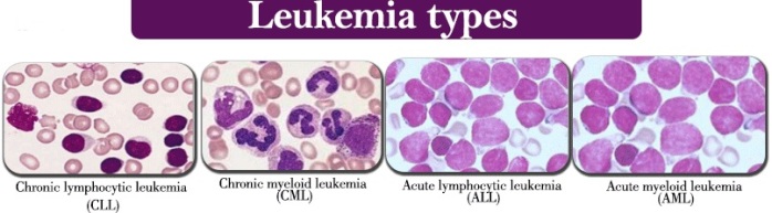 Acute-myeloid-leukemia2