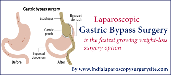 Get The Idea Of Laparoscopic Gastric Bypass Surgery With Advantages Of Planning Treatment In India